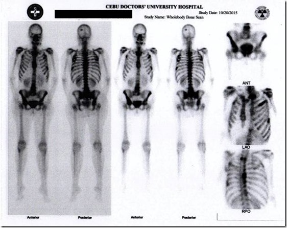 bone scan of morphine damage